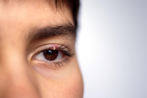 Stye on a child's eye.