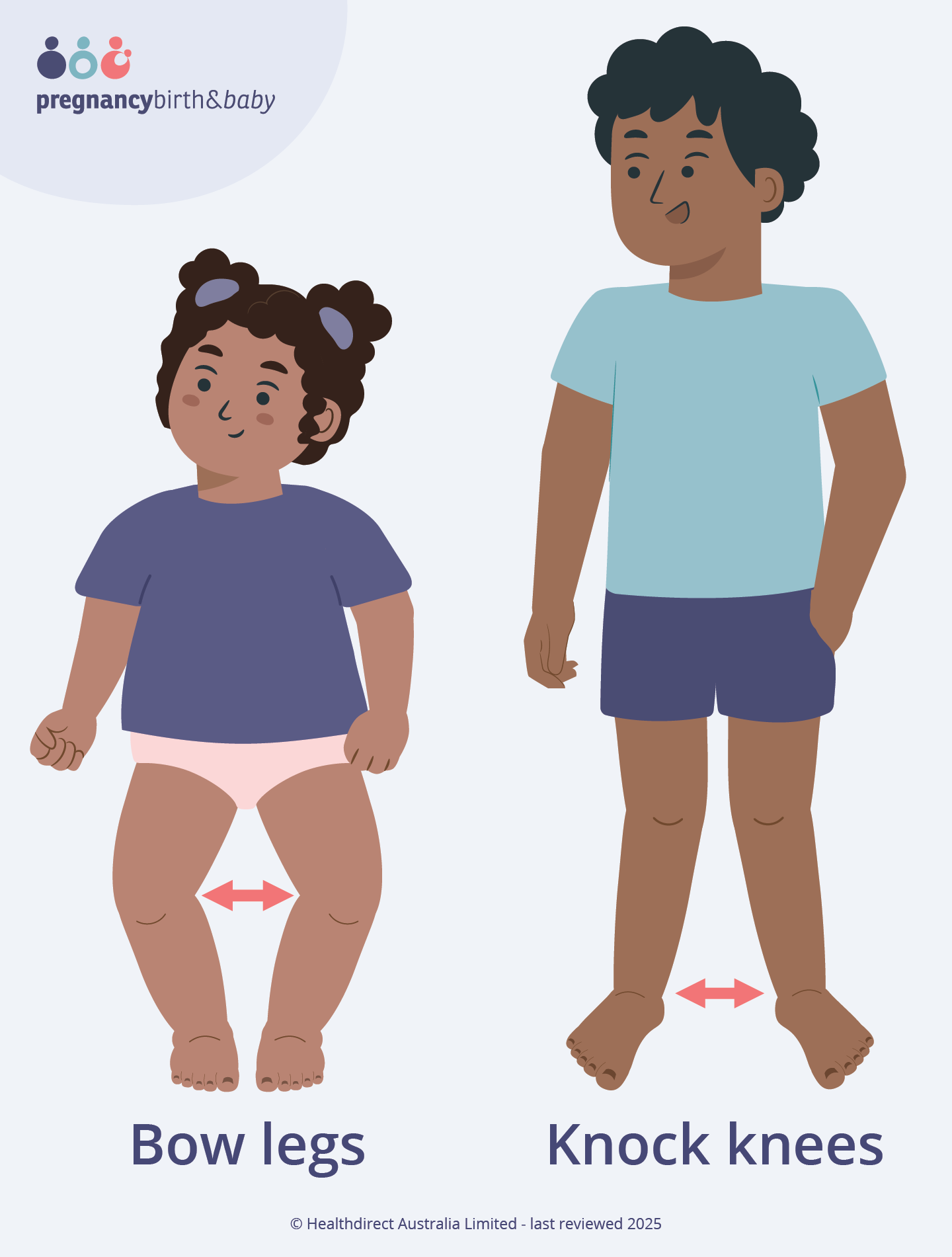 Illustration of a toddler with bow legs standing next to an older child with knock knees.