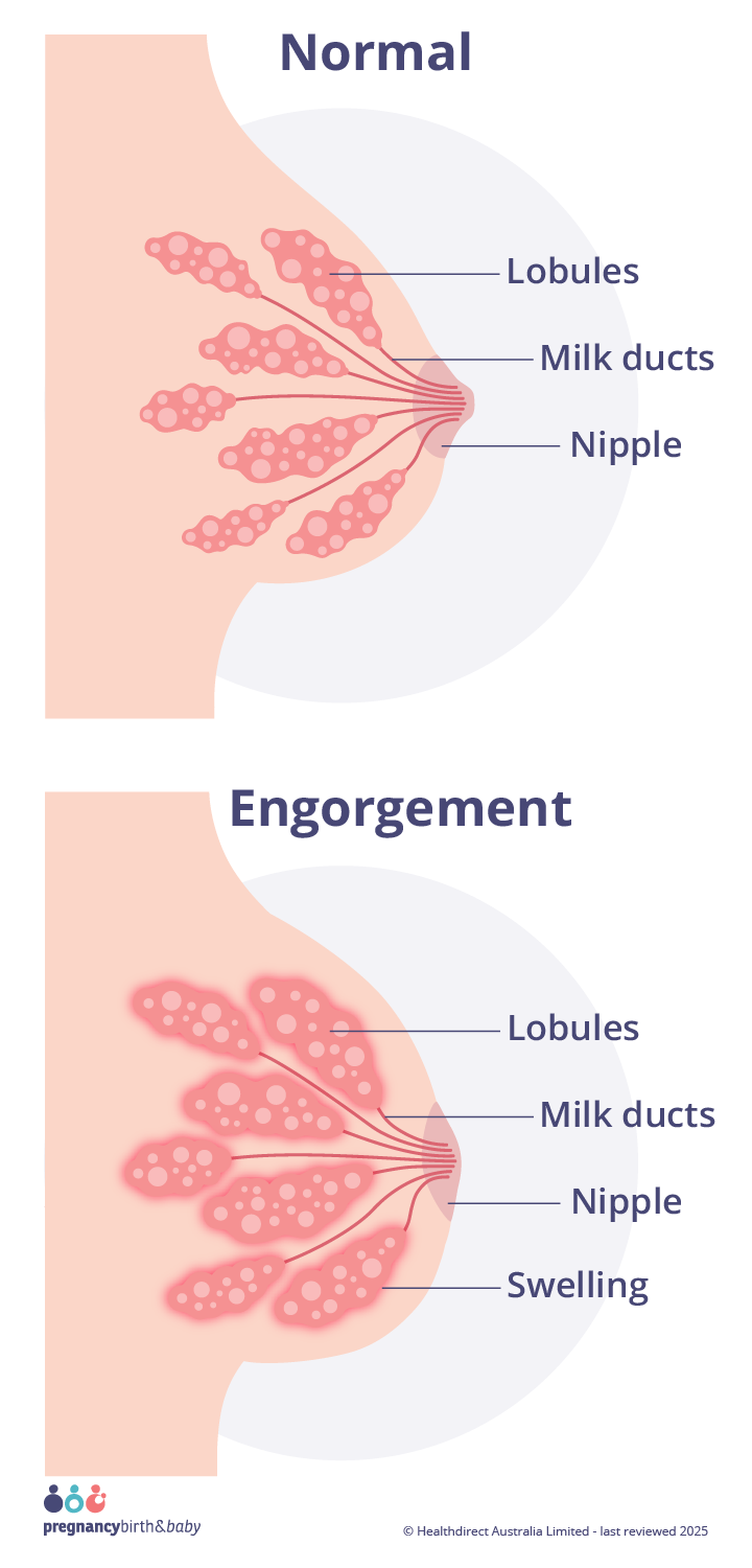 Portrait illustration of a normal breast and lobules, alongside a breast with engorgement and swollen lobules.