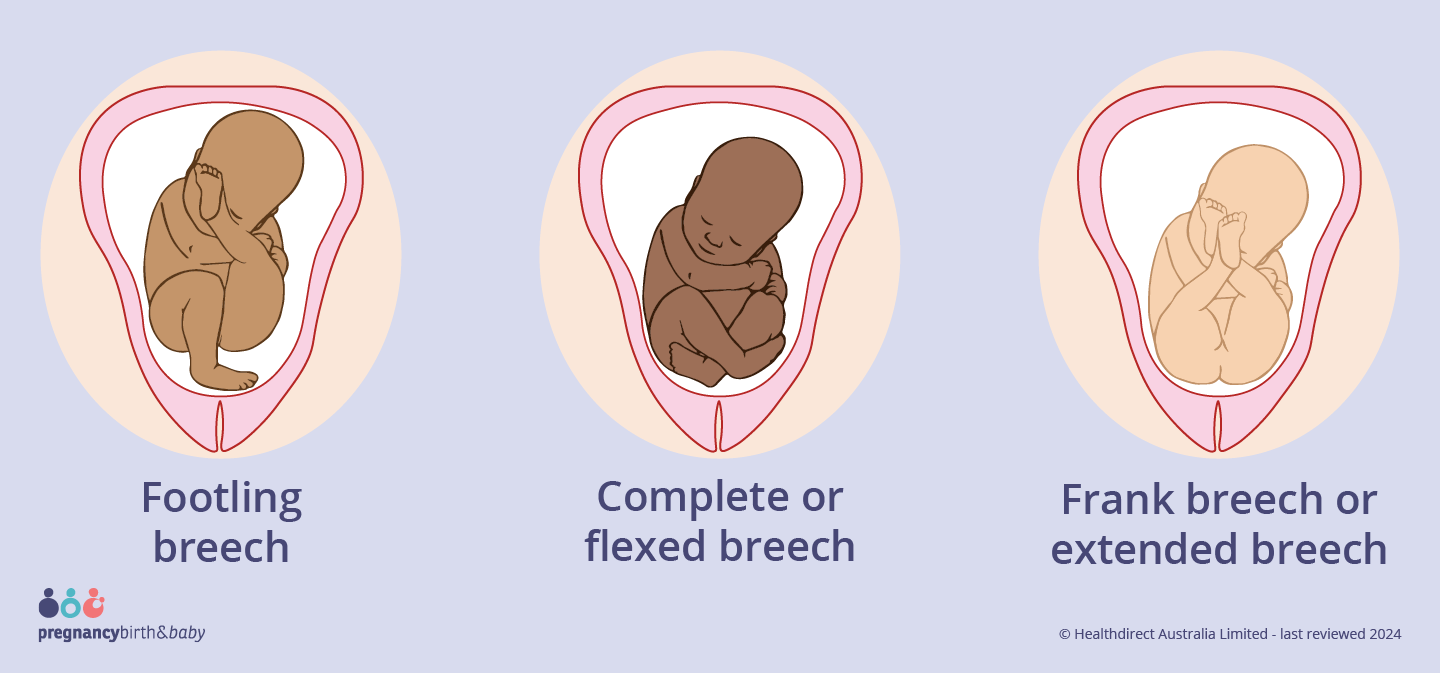 Illustration showing the 3 most common types of breech positions: footling breech, complete or flexed breech and frank or extended breech.