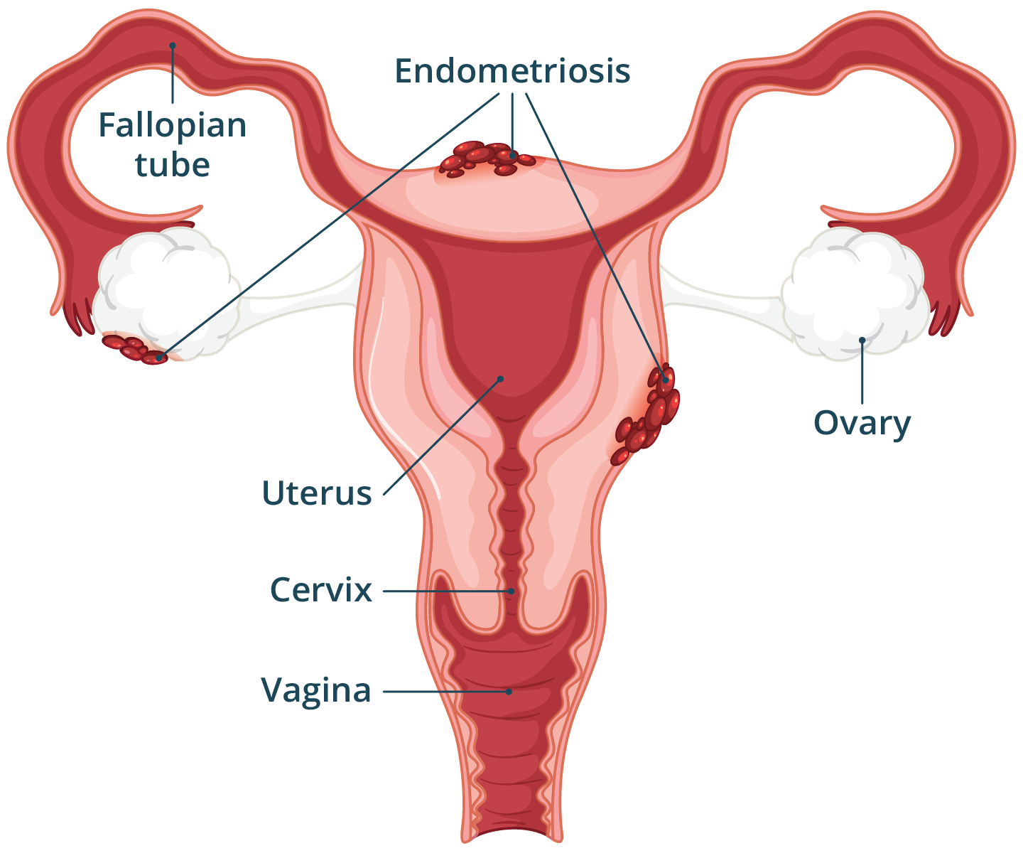 Illustration of the female reproductive system with endometriosis occurring outside of the uterus.