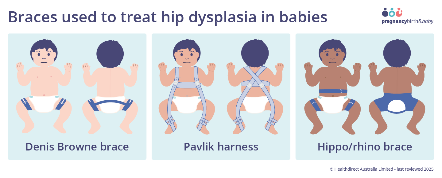 Diagram showing braces to treat hip dysplasia.