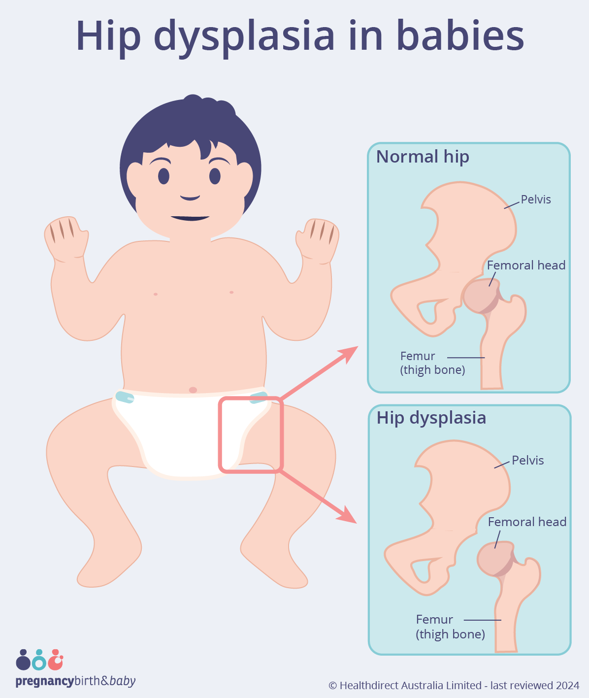 Diagram showing hip dysplasia.