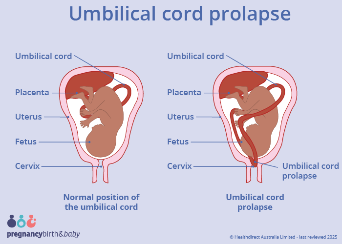 Illustration of an umbilical cord prolapse