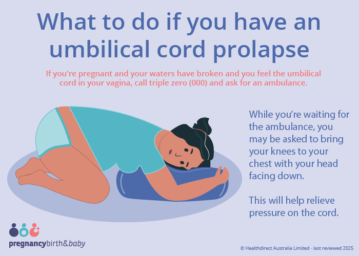What to do if you have umbilical cord prolapse