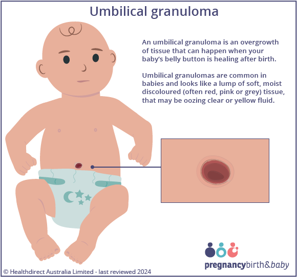 Illustration of an umbilical granuloma.