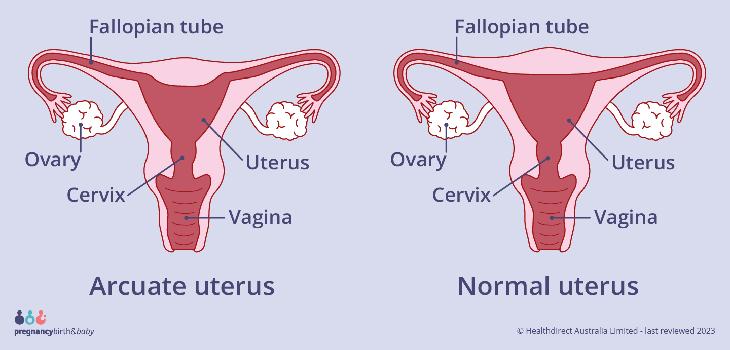 The arcuate uterus looks very similar to a normal uterus but has a small dip at the top of the womb.