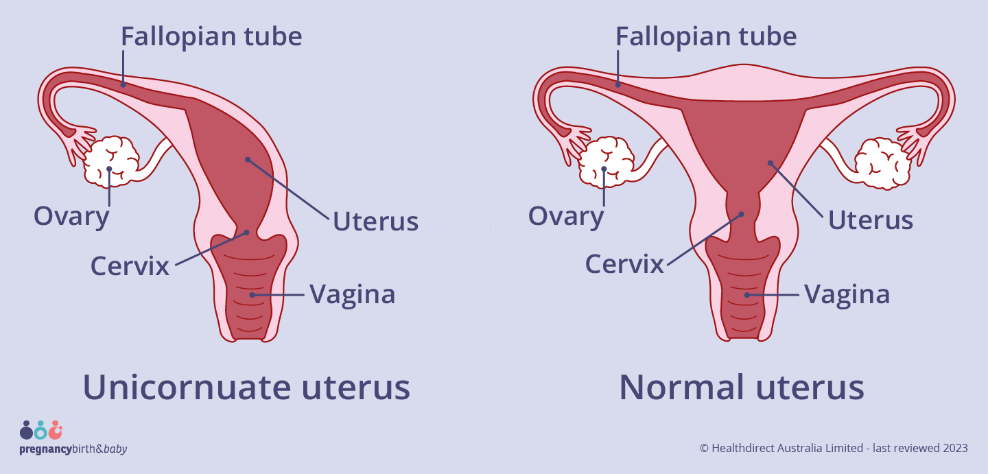 A unicornate uterus means that the womb is half the usual size, and occurs because half of the uterus didn’t develop as expected.